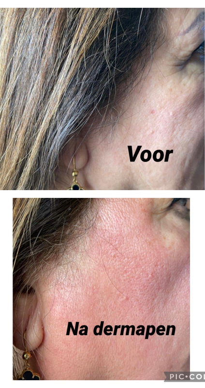 gezichtsbehandeling zwolle dermamapping